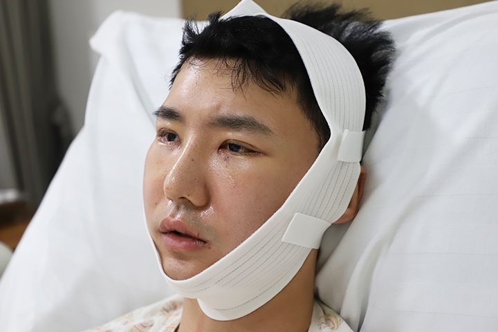 Jaw Augmentation