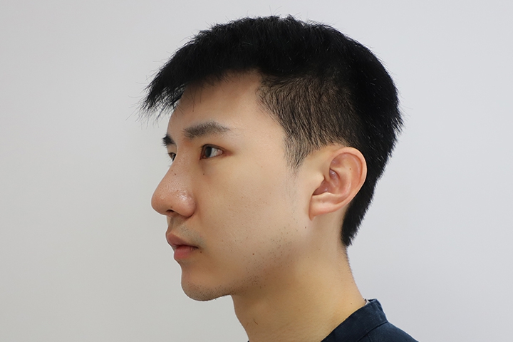 Jaw Augmentation