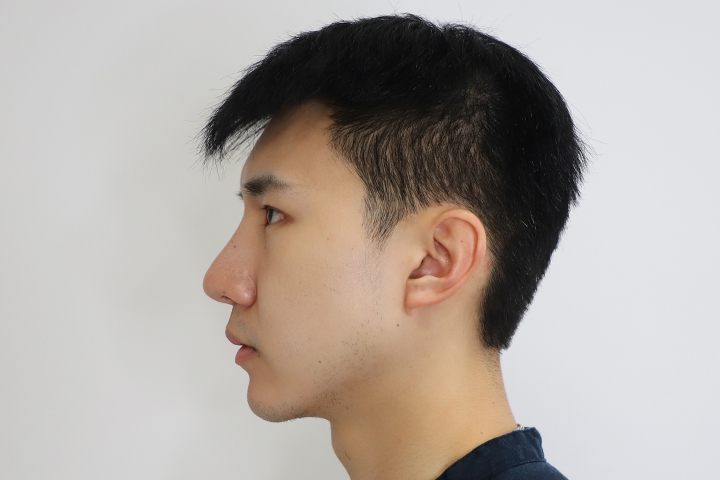 Jaw Augmentation