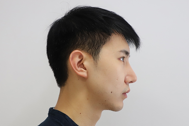 Jaw Augmentation