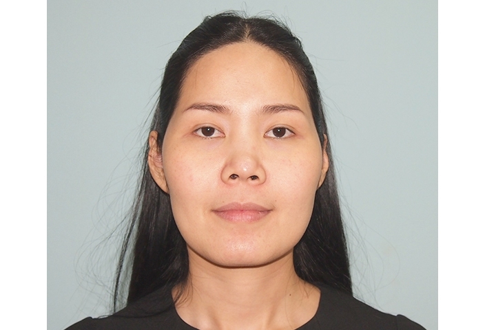 Cheekbone Reduction, Zygoma Reduction
