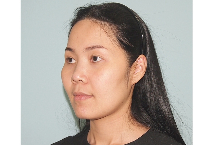 Cheekbone Reduction, Zygoma Reduction