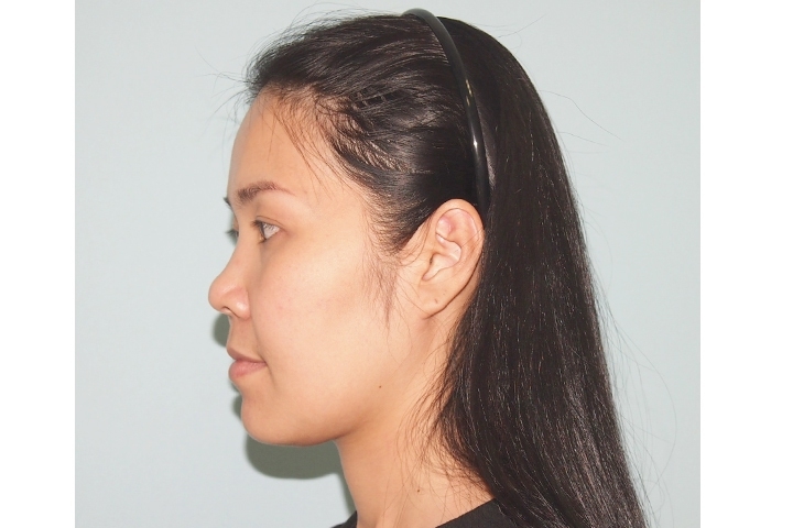 Cheekbone Reduction, Zygoma Reduction