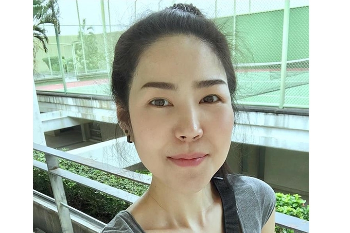 Cheekbone Reduction, Zygoma Reduction