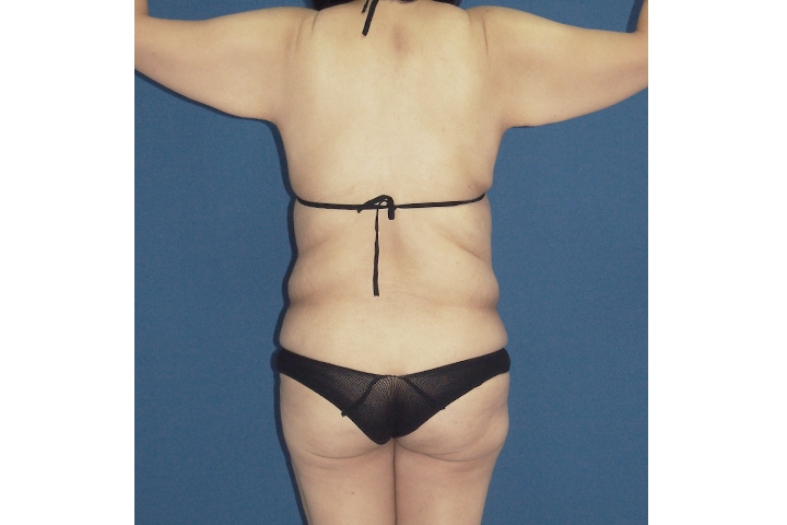 Body Contouring