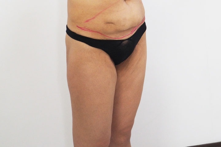 Thighs Lift