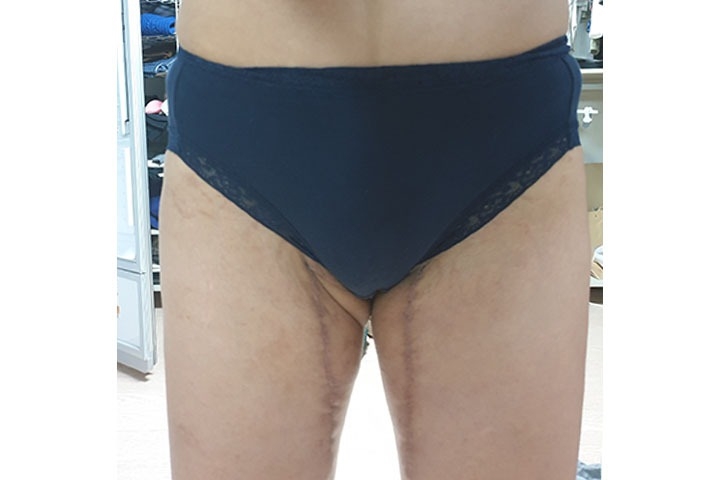 Thighs Lift