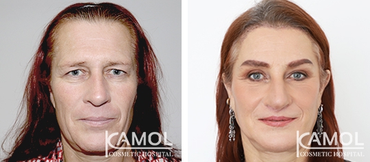 Cirurgia de Feminização Facial