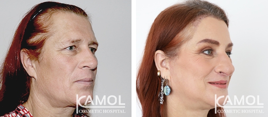 Cirurgia de Feminização Facial