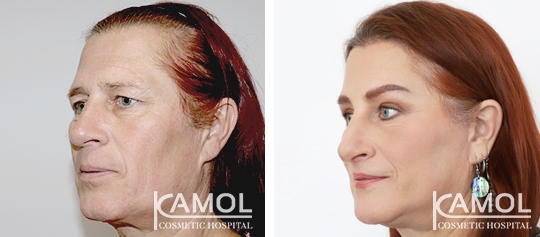 Cirurgia de Feminização Facial