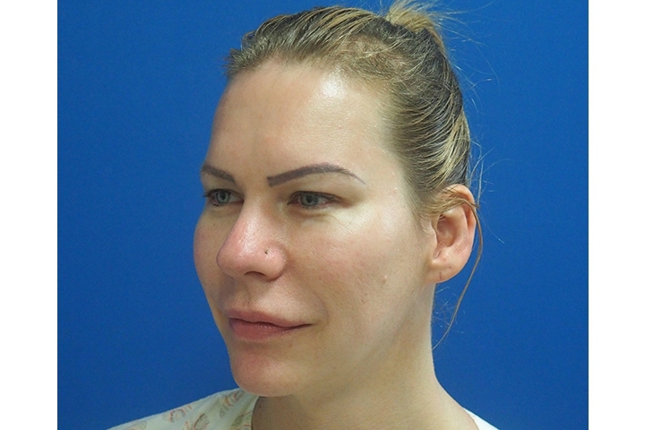 la racine des cheveux aux sourcils