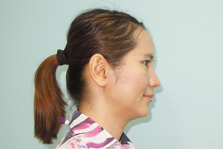 L’otoplastie