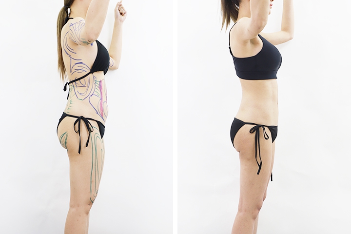 Liposuccion