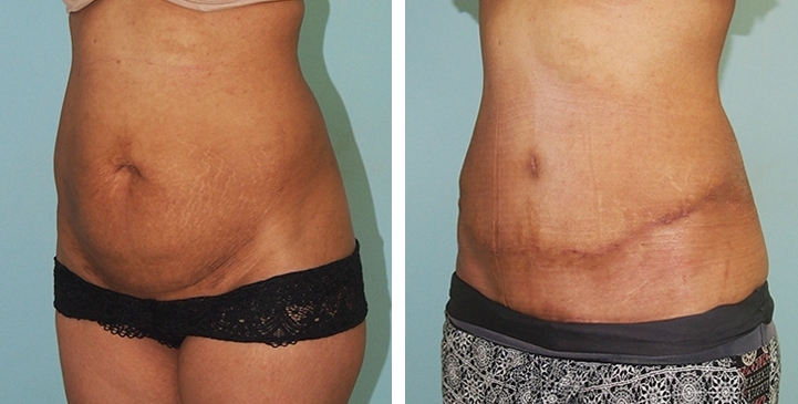 Lipectomie
