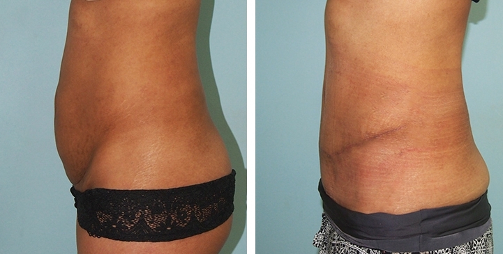 Lipectomie