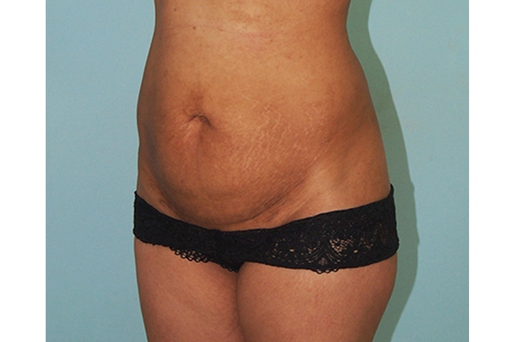 Lipectomie