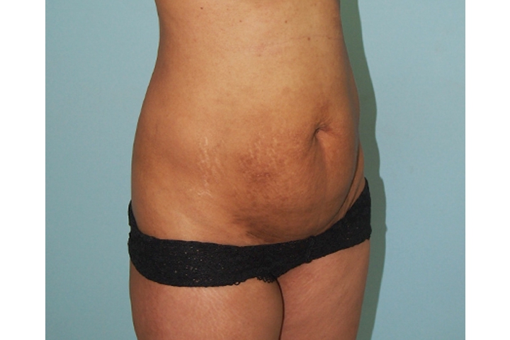 Lipectomie