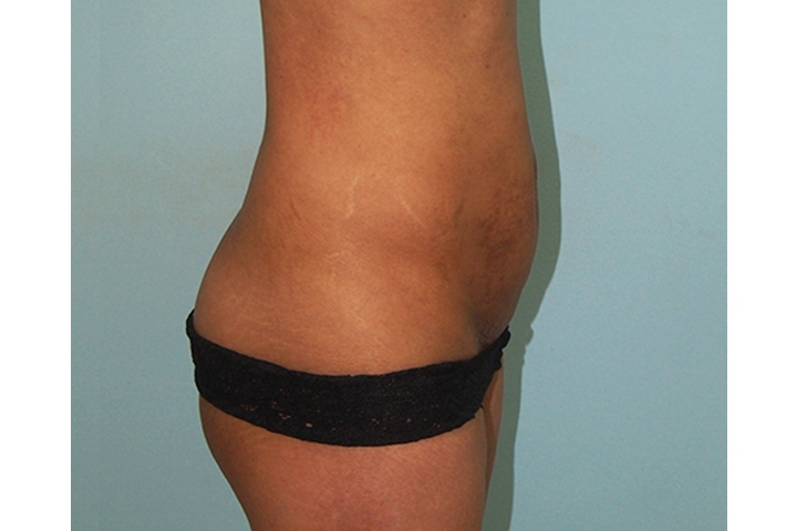 Lipectomie