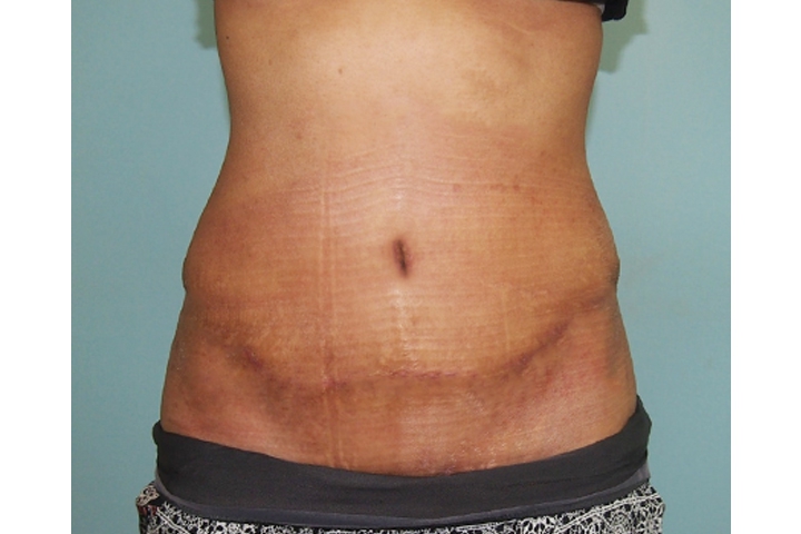 Lipectomie