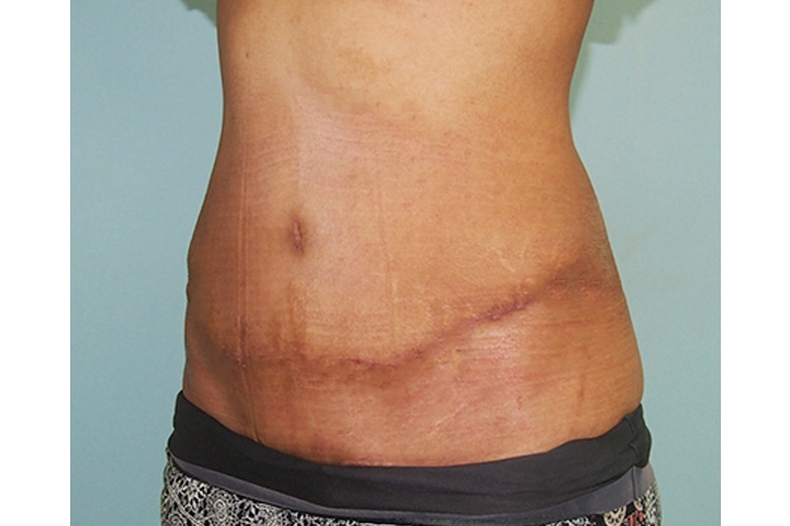 Lipectomie