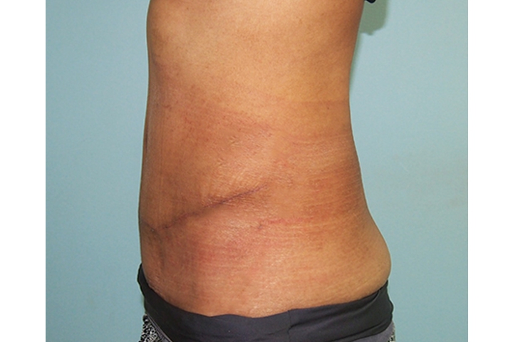 Lipectomie