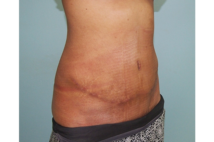 Lipectomie