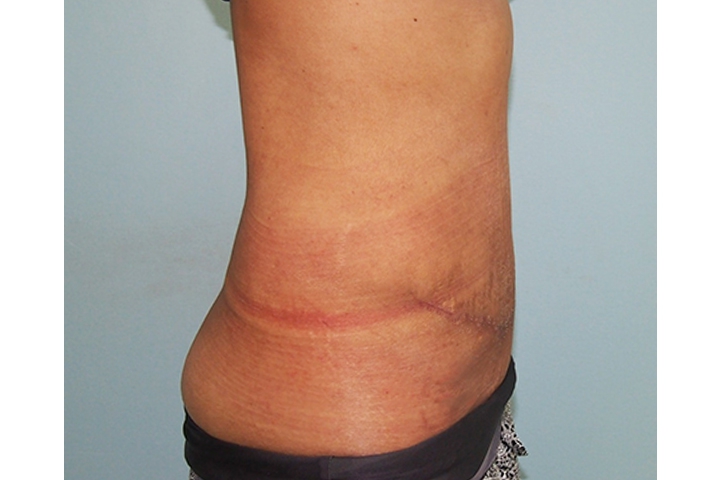 Lipectomie
