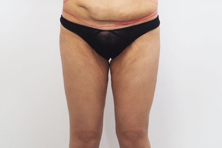 Avis sur le lifting des cuisses