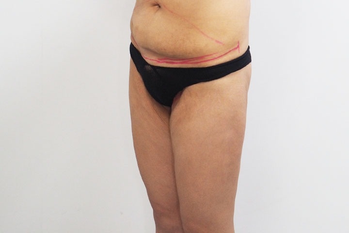 Avis sur le lifting des cuisses