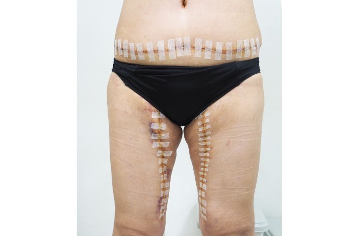 Avis sur le lifting des cuisses