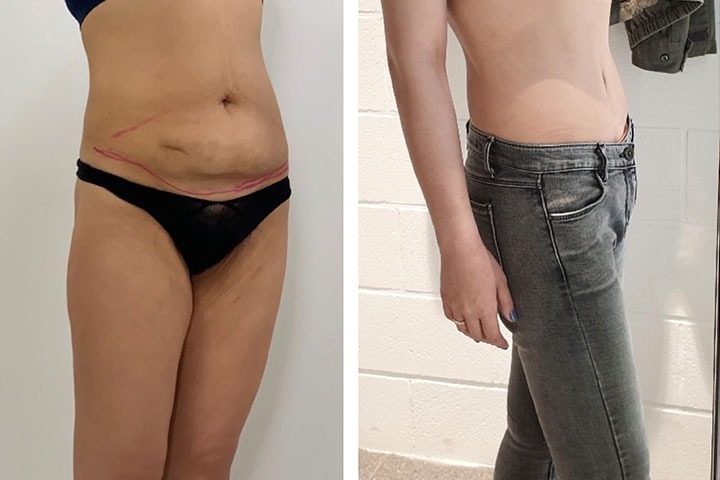 Avis sur le lifting des cuisses