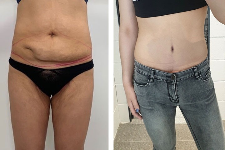 Avis sur le lifting des cuisses