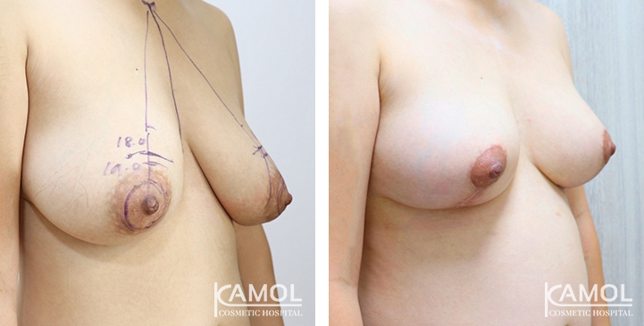 Breast Lift