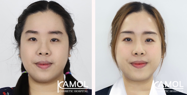 Epicanthoplasty + double eyelid surgery