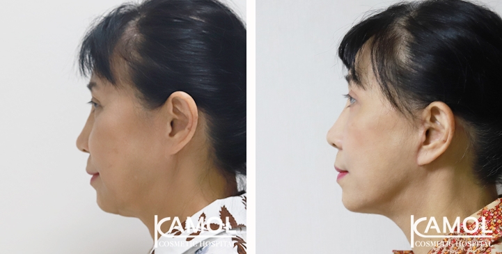 Estiramiento Facial  Kamol Cosmetic Hospital