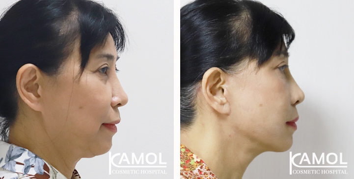 Estiramiento Facial  Kamol Cosmetic Hospital