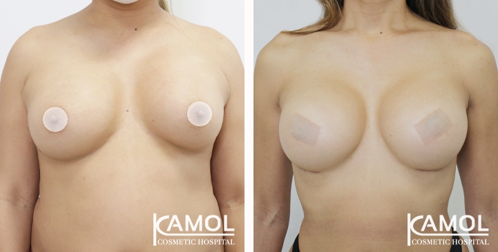 Breast lift and breast reduction after surgery 1 year (1)