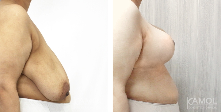 Before after 05-1 0