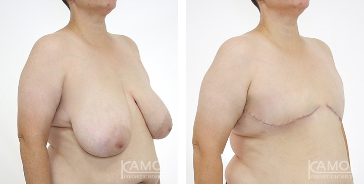 Before after pattern01 0