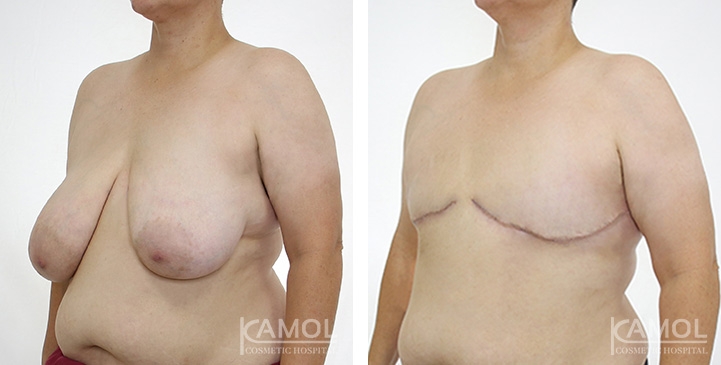 Before after pattern03 0