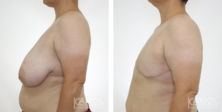 Before after pattern04 0