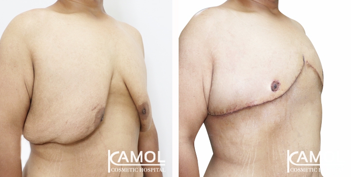 Gynecomastia surgery