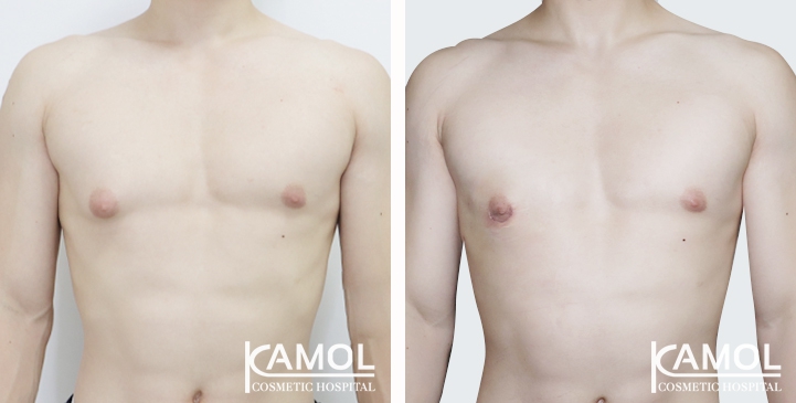 Gynecomastia surgery