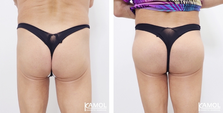 Buttock Augmentation 300 CC