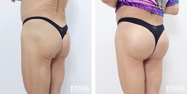 Buttock Augmentation 300 CC