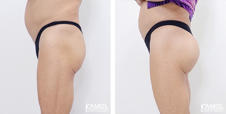 Buttock Augmentation 300 CC