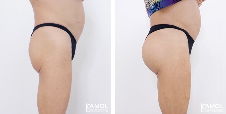 Buttock Implant  Kamol Cosmetic Hospital