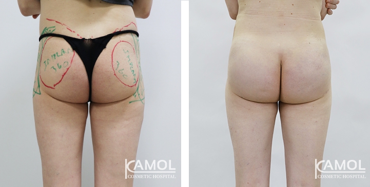 Buttock Augmentation 360 CC