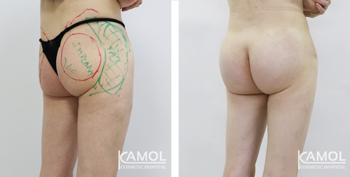 Buttock Augmentation 360 CC