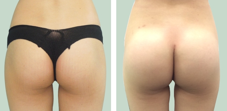 Buttock Augmentation 300 CC